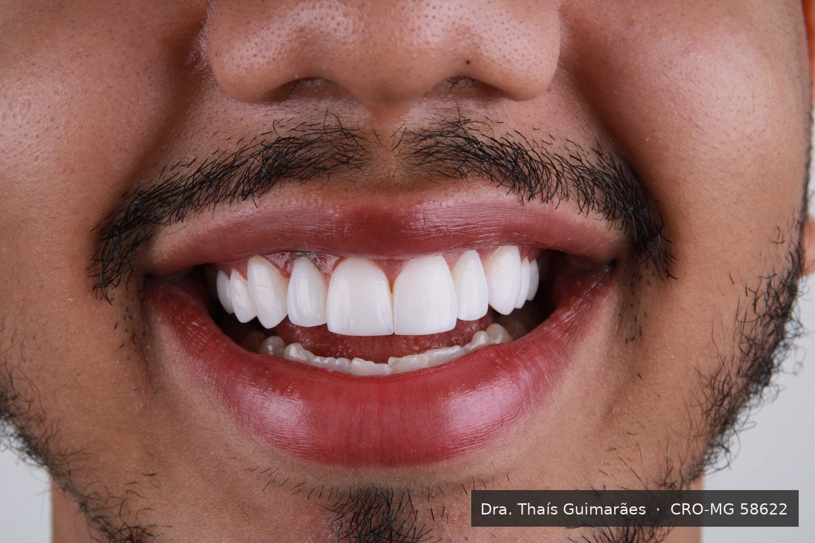 Sorriso finalizado após lentes de contato dental — paciente da Dra. Thaís Guimarães